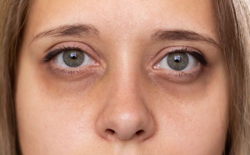 How to Remove Dark Circles Under Eyes Naturally in One Week